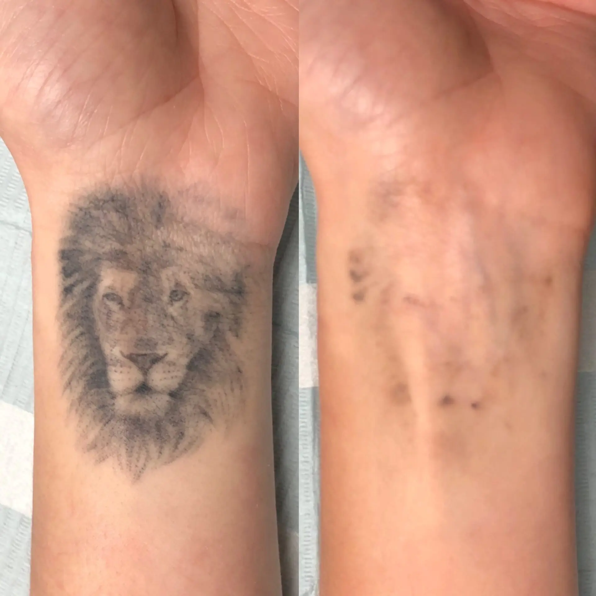 tattoo removal before and after
